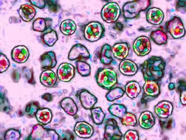 Measles-related deaths in Pennsylvania rise to 4, health officials say